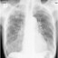 Pneumoconiosis