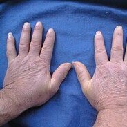 scleroderma