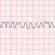 Ventricular fibrillation