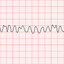 Ventricular fibrillation