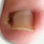 Ingrown Toenail
