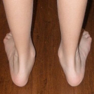 VALGUS
