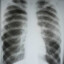 PNEUMOTHORAX