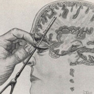 the lobotomy