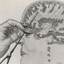 the lobotomy