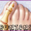 Bunions