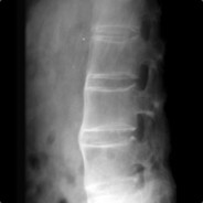 ankylosing spondylitis