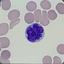T-cell Lymphoma