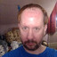 Balding at 22