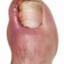 Ingrown Toenail