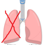 Left Lung