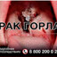 Рак горла