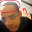 Earl Sweatshirt's Hairline