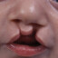 cleftlip