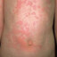 URTICARIA