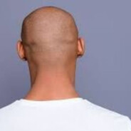 أصلع رأسه مميتة