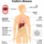 HEX: CROHN&#039;S DISEASE